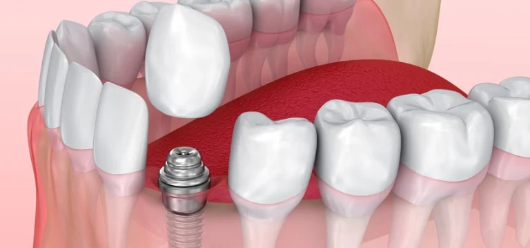 Restore Your Smile with Dental Implants in Tarzana, CA