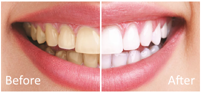 Get a Brighter Smile with Teeth Whitening in Tarzana, CA